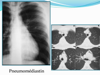 Pneumomédiastin
 