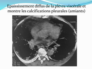 Epaississement diffus de la plèvre viscérale et
montre les calcifications pleurales (amiants)
 