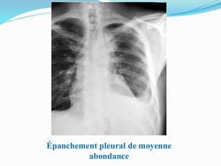 Épanchement pleural de moyenne
abondance
 
