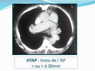 HTAP : tronc de l ’AP
= ou > à 30mm
 