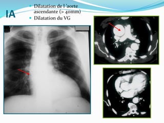 IA
 Dilatation de l ’aorte
ascendante (> 40mm)
 Dilatation du VG
 