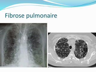 Fibrose pulmonaire
 