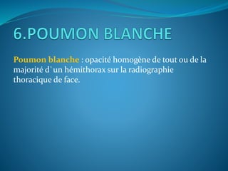 Poumon blanche : opacité homogène de tout ou de la
majorité d`un hémithorax sur la radiographie
thoracique de face.
 