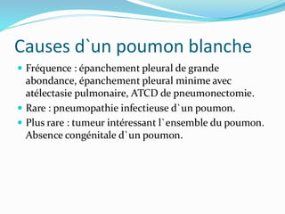 Causes d`un poumon blanche
 Fréquence : épanchement pleural de grande
abondance, épanchement pleural minime avec
atélectasie pulmonaire, ATCD de pneumonectomie.
 Rare : pneumopathie infectieuse d`un poumon.
 Plus rare : tumeur intéressant l`ensemble du poumon.
Absence congénitale d`un poumon.
 