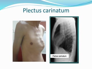 Plectus carinatum
 