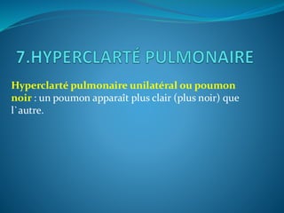 Hyperclarté pulmonaire unilatéral ou poumon
noir : un poumon apparaît plus clair (plus noir) que
l`autre.
 