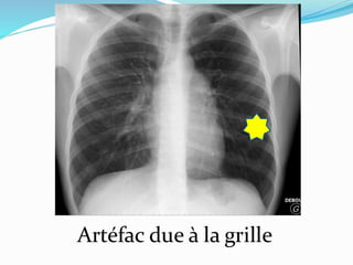 Artéfac due à la grille
 