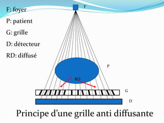 F
P
G
D
Principe d’une grille anti diffusante
RD
F: foyer
P: patient
G: grille
D: détecteur
RD: diffusé
 