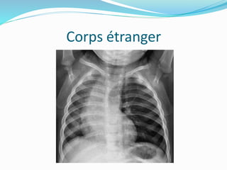 Corps étranger
 