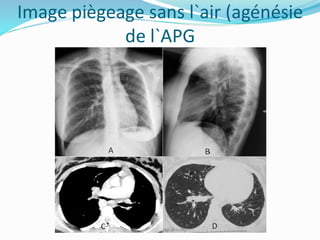 Image piègeage sans l`air (agénésie
de l`APG
 