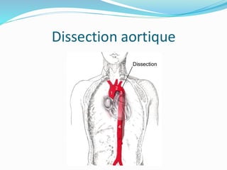 Dissection aortique
 