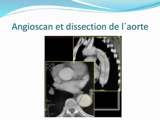 Angioscan et dissection de l`aorte
 