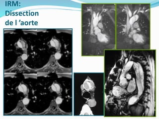 IRM:
Dissection
de l ’aorte
 