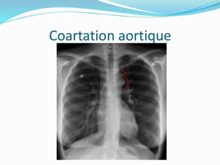 Coartation aortique
 