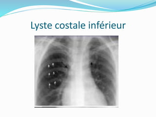 Lyste costale inférieur
 