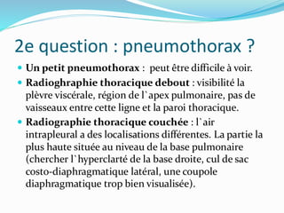 2e question : pneumothorax ?
 Un petit pneumothorax : peut être difficile à voir.
 Radioghraphie thoracique debout : visibilité la
plèvre viscérale, région de l`apex pulmonaire, pas de
vaisseaux entre cette ligne et la paroi thoracique.
 Radiographie thoracique couchée : l`air
intrapleural a des localisations différentes. La partie la
plus haute située au niveau de la base pulmonaire
(chercher l`hyperclarté de la base droite, cul de sac
costo-diaphragmatique latéral, une coupole
diaphragmatique trop bien visualisée).
 