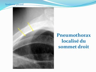 Syndrome pleural
Pneumothorax
localisé du
sommet droit
 