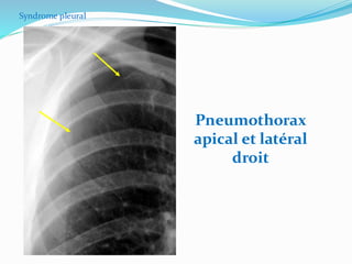 Pneumothorax
apical et latéral
droit
Syndrome pleural
 