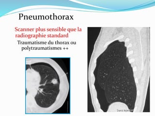 Pneumothorax
Scanner plus sensible que la
radiographie standard
Traumatisme du thorax ou
polytraumatismes ++
 