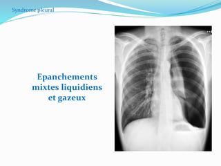 Syndrome pleural
Epanchements
mixtes liquidiens
et gazeux
 