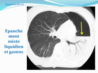 Syndrome pleural
Epanche
ment
mixte
liquidien
et gazeux
 