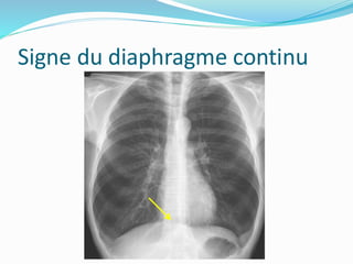 Signe du diaphragme continu
 