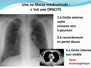 Une ne Masse médiastinale :
c ’est une OPACITE
convexe vers
le poumon
2.à raccordement
en pente douce
3.à limite interne
non visible
1.à limite externe
nette
Kyste
bronchogénique
 