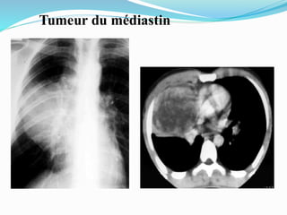 Tumeur du médiastin
 