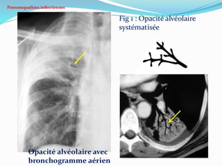Pneumopathies infectieuses
Fig 1 : Opacité alvéolaire
systématisée
Opacité alvéolaire avec
bronchogramme aérien
 