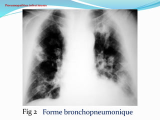 Pneumopathies infectieuses
Forme bronchopneumonique
Fig 2
 