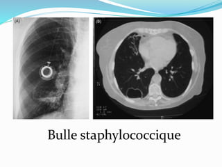 Bulle staphylococcique
 