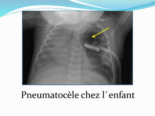 Pneumatocèle chez l`enfant
 