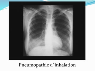 Pneumopathie d`inhalation
 
