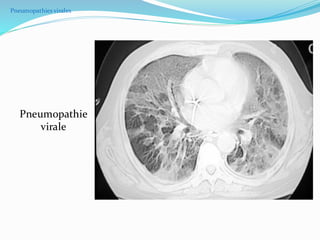 Pneumopathies virales
Pneumopathie
virale
 