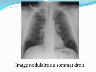 Image nodulaire du sommet droit
 