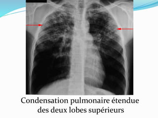 Condensation pulmonaire étendue
des deux lobes supérieurs
 