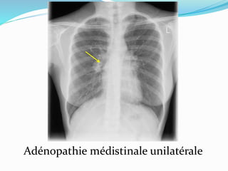 Adénopathie médistinale unilatérale
 