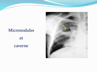 Micronodules
et
caverne
 