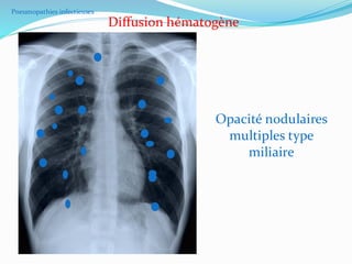 Diffusion hématogène
Opacité nodulaires
multiples type
miliaire
Pneumopathies infectieuses
 