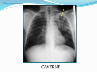 Tuberculose pulmonaire
CAVERNE
 