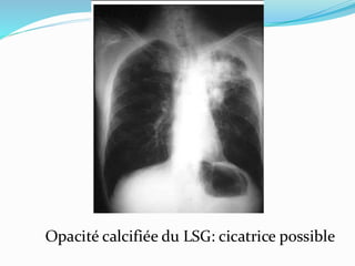 Opacité calcifiée du LSG: cicatrice possible
 