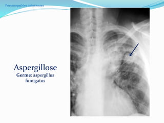 Pneumopathies infectieuses
Aspergillose
Germe: aspergillus
fumigatus
 
