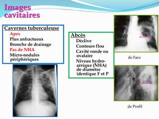 Images
cavitaires
Abcès
Déclive
Contours flou
Cavité ronde ou
ovalaire
Niveau hydro-
aérique (NHA)
de diamètre
identique F et P
Cavernes tuberculeuse
Apex
Plus anfractueux
Bronche de drainage
Pas de NHA
Micro-nodules
périphériques de Face
de Profil
 