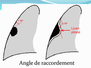 Angle de raccordement
 