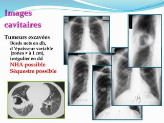 Images
cavitaires
Tumeurs excavées
Bords nets en dh,
d ’épaisseur variable
(zones > à 1 cm),
irrégulier en dd
NHA possible
Séquestre possible
 