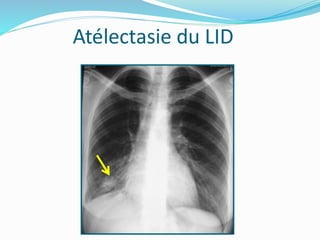 Atélectasie du LID
 