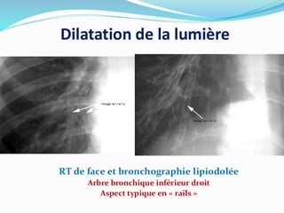 Dilatation de la lumière
RT de face et bronchographie lipiodolée
Arbre bronchique inférieur droit
Aspect typique en « rails »
 