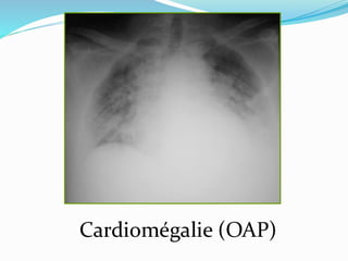 Cardiomégalie (OAP)
 