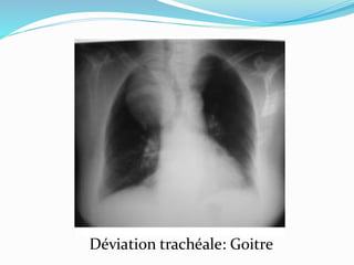Déviation trachéale: Goitre
 