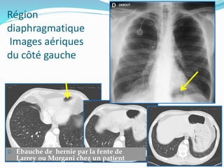 Région
diaphragmatique
Images aériques
du côté gauche
Ébauche de hernie par la fente de
Larrey ou Morgani chez un patient
distendu.
 